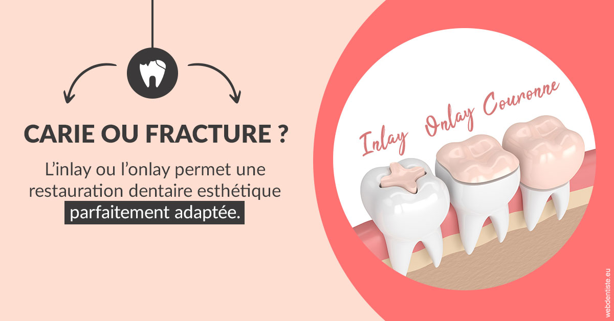 https://dr-langlade-philippe.chirurgiens-dentistes.fr/T2 2023 - Carie ou fracture 2