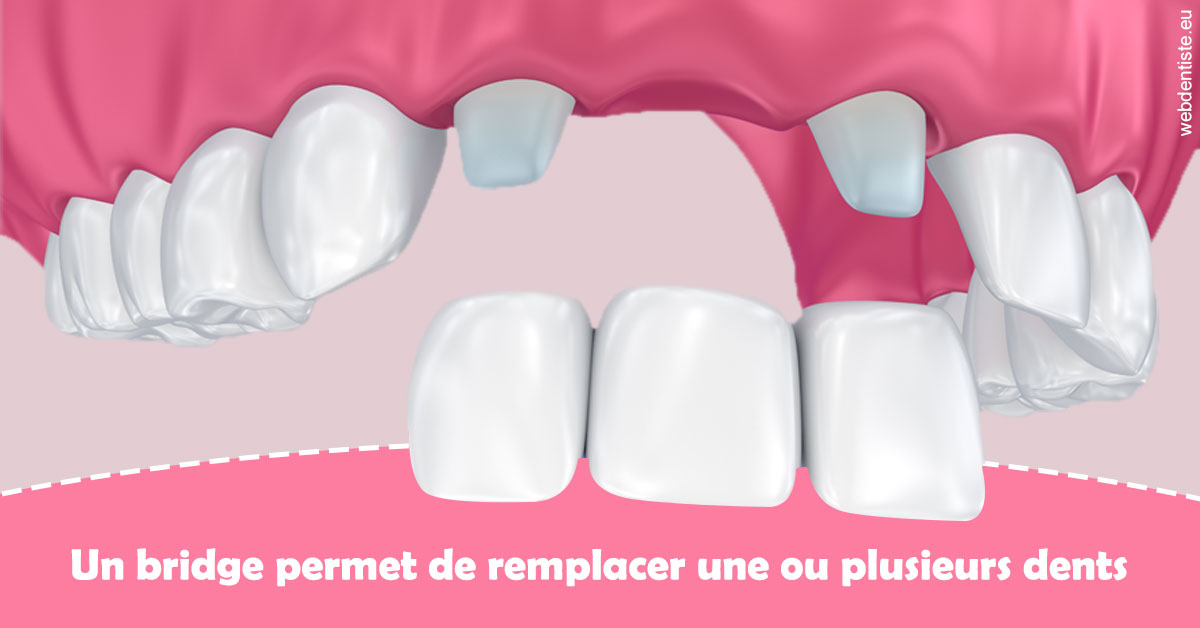 https://dr-langlade-philippe.chirurgiens-dentistes.fr/Bridge remplacer dents 2